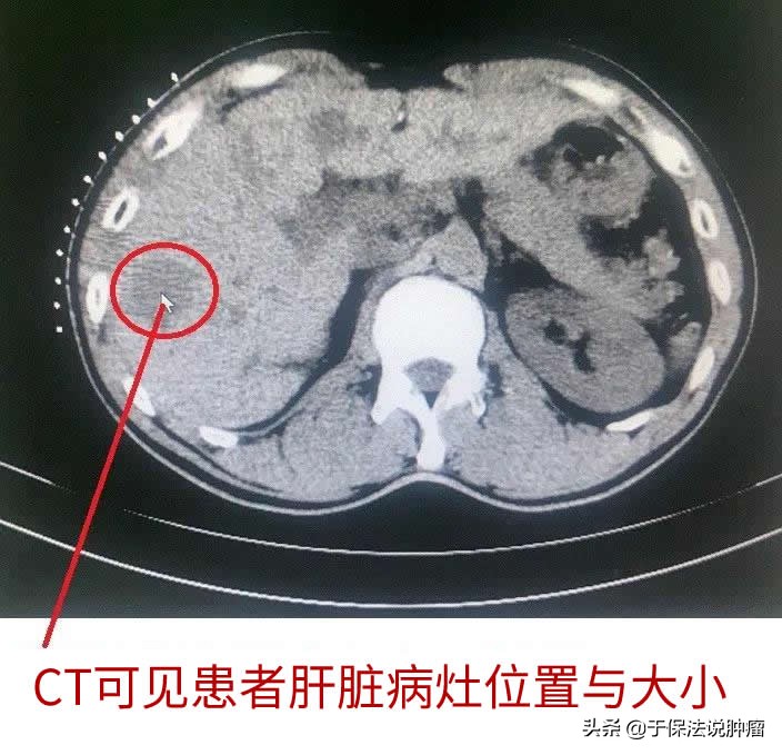 肝癌手术7年复发，经缓释库靶向治疗，至今又已生存超过5年