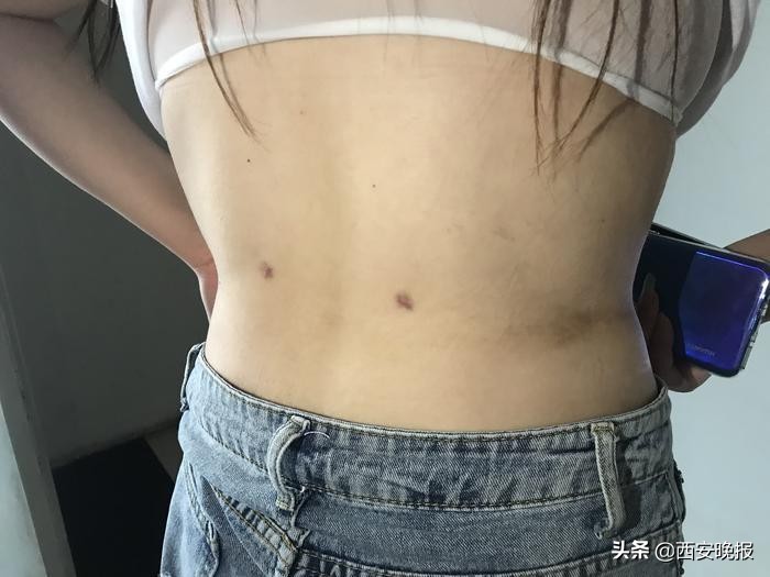 女子接受吸脂手术后腹部凹陷变形，维权遭遇举证难尴尬