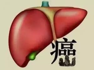 肝细胞癌特效药卡博替尼获日本批准