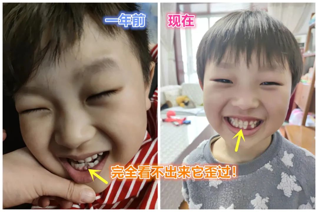 为什么现在的孩子换个牙这么费劲？乳牙迟迟不掉是缺钙吗？