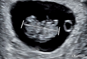 怀孕后早孕期B超图怎么看？医生详解，图文并茂