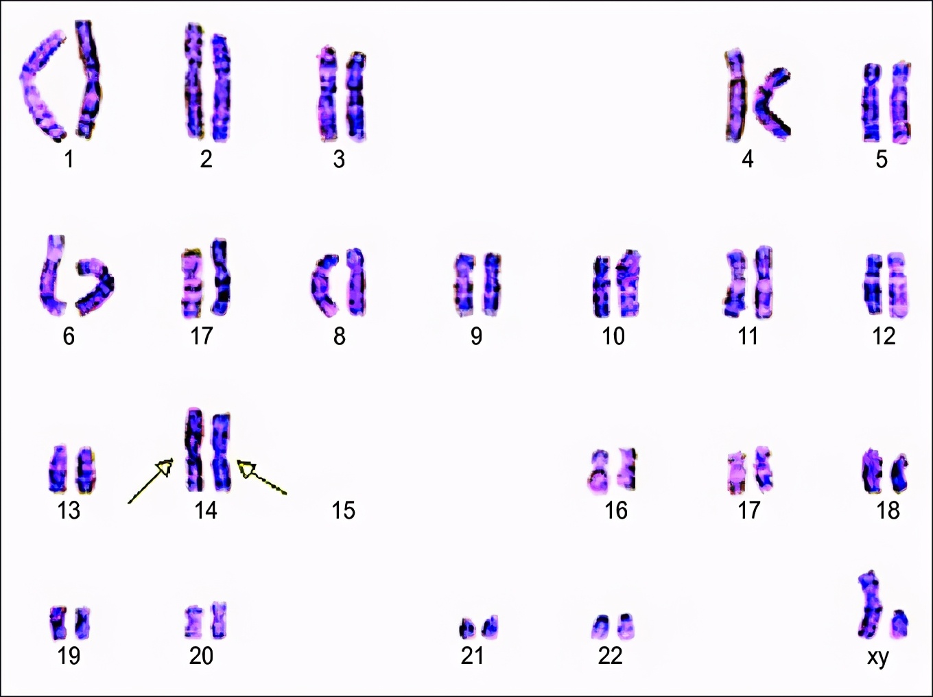 只有22对染色体不过也有极少数特殊的人类,由于十分偶然的染色体变异