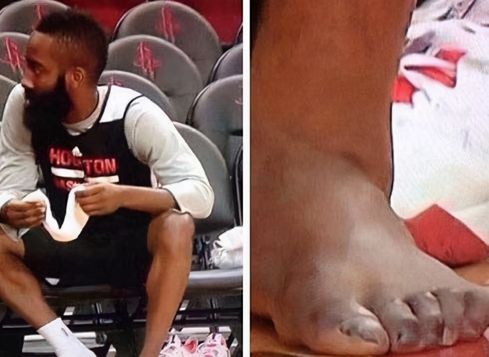 看照片才知打NBA多不易！羅斯膝蓋留長長傷疤，詹姆斯腳趾變形