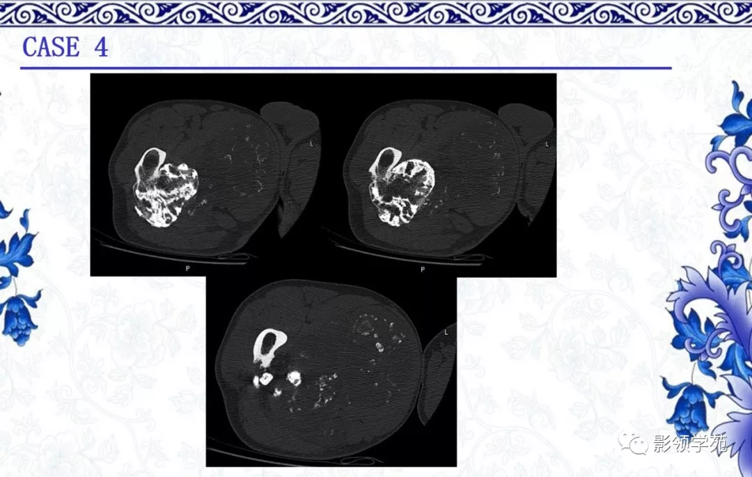 7种常见的软骨源性肿瘤的影像表现