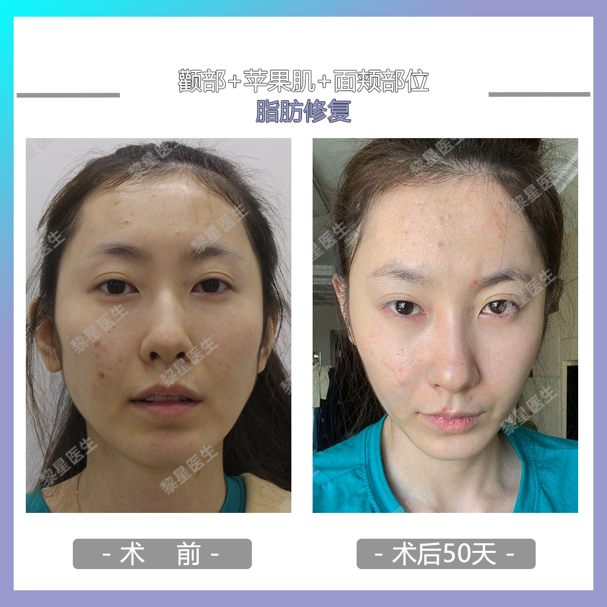 淚溝填充顯老 蘋果肌填充下垂 脂肪填充失敗有沒有 後悔藥 黎星醫生 Mdeditor