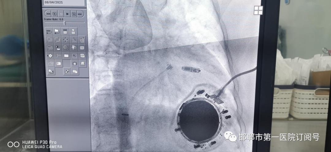 邯郸市第一医院成功完成邯郸市首例Micra无导线起搏器植入手术，起搏器仅重1.75克
