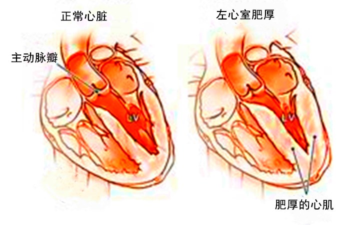 高血压病人，为什么血压高了早搏多、发“房颤”？