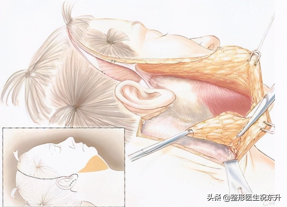 拉皮手术后是什么感觉？听听医生怎么说