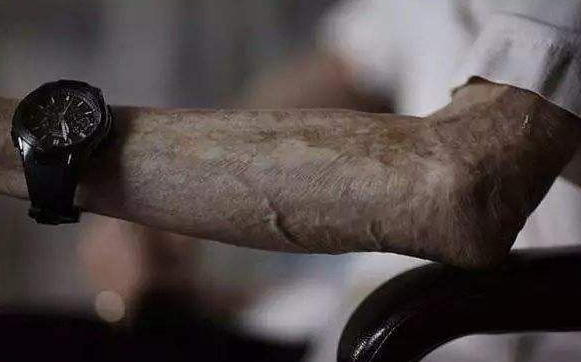 日本原子弹爆炸后的幸存者，终身痛苦，希望世