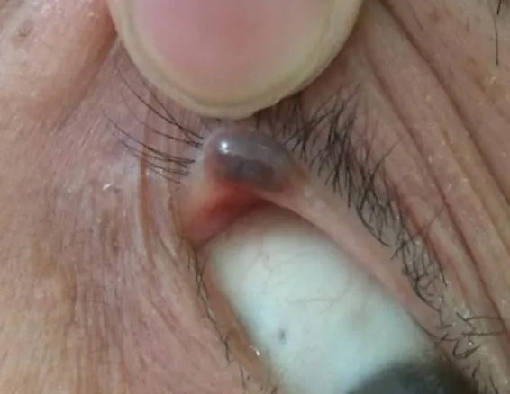 科普——眼整形手术是个什么手术?(多图)