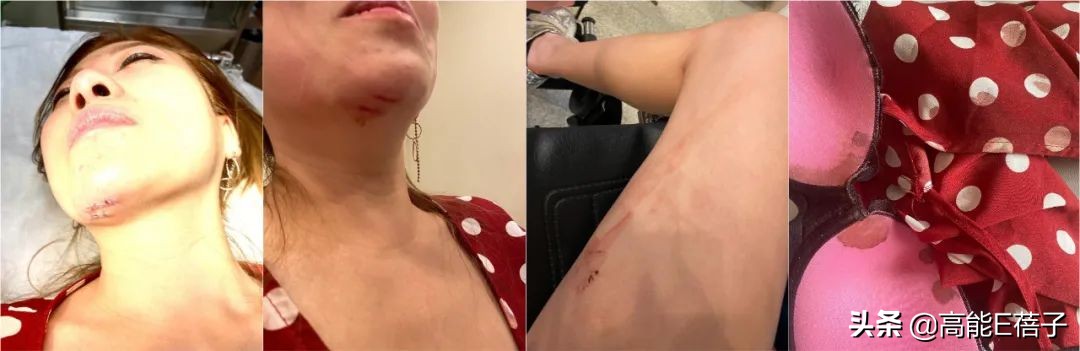 38岁香港女歌手被陌生外国女子三连踢破相，此前