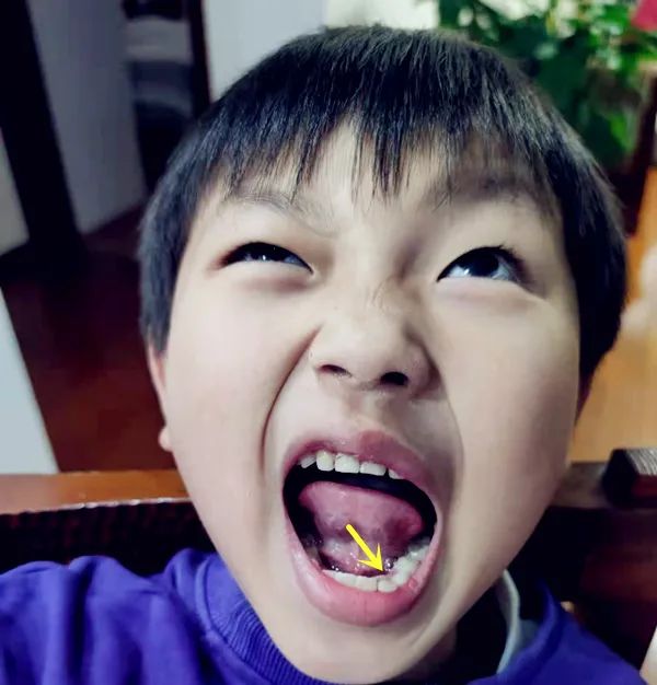 为什么现在的孩子换个牙这么费劲？乳牙迟迟不掉是缺钙吗？