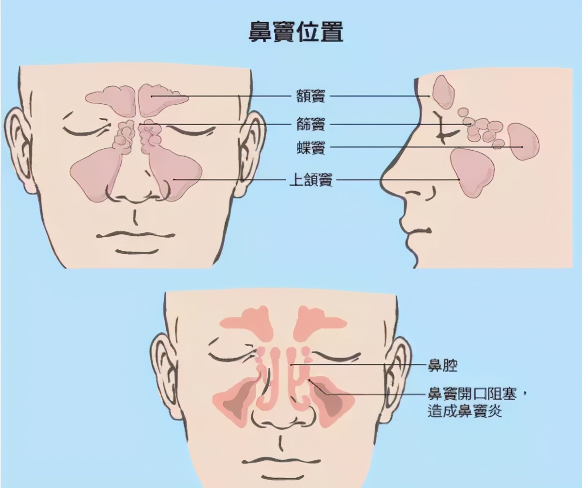 鼻炎 or 鼻窦炎？一鼻之差，症状大不同