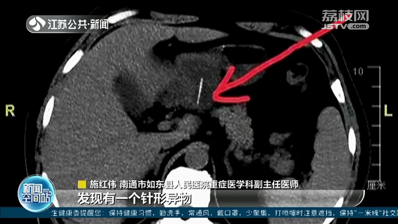 南通大叔感染性休克送进ICU 医生从肝脏里取出半截牙签