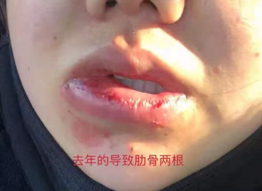 800万粉网红被控家暴，妻子晒多张照片肋骨被打断，孩子跪地求饶
