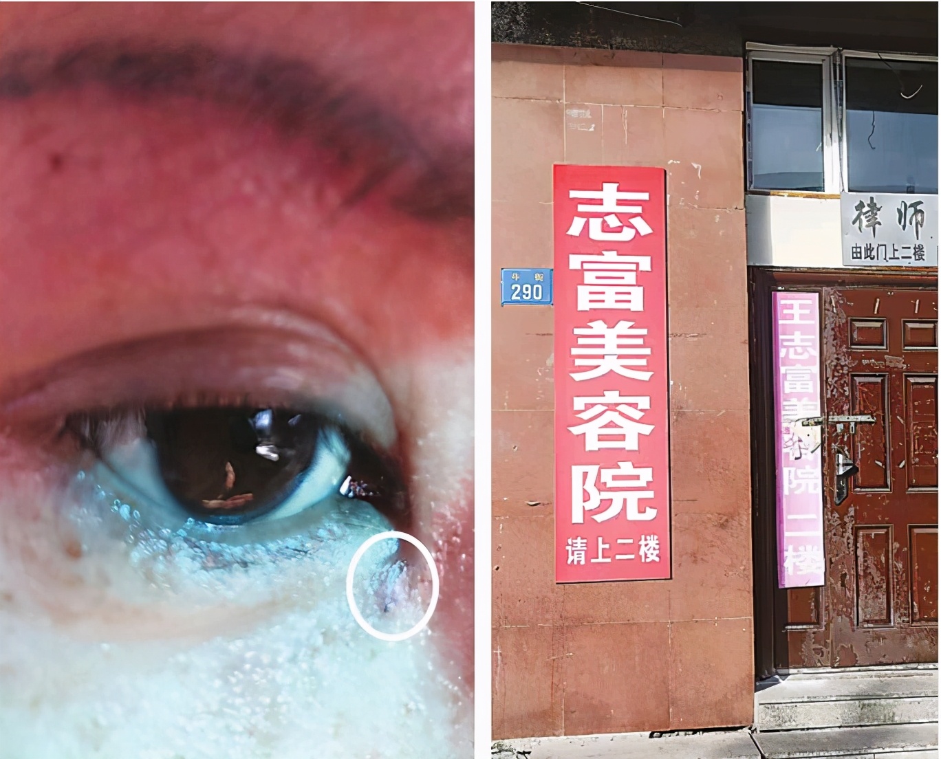 美容手术出现问题后，美容院“玩失踪”，维权被拉黑，手术“开眼角”拆线落线头