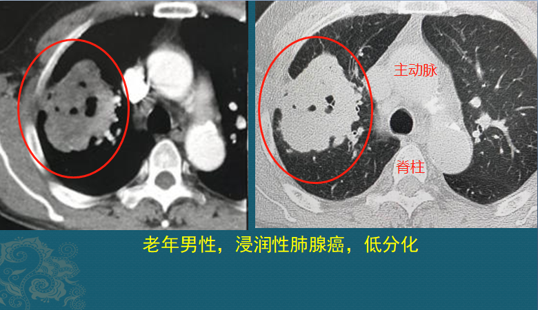 磨玻璃肺结节随访观察，会不会变成肺癌？医生带你看随访4种结局