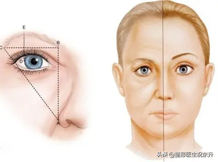 “提眉手术”后眼睛会老得更快、更难看？听医生说真相