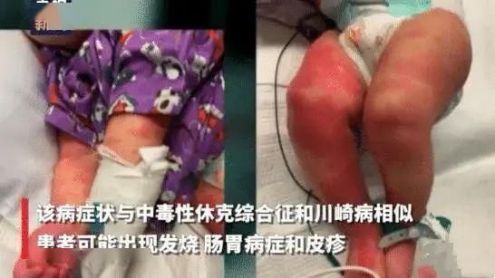 新型病毒在美国出现可怕变异：不仅攻击呼吸系