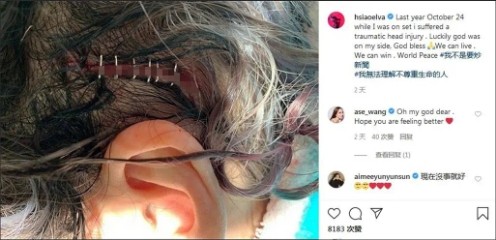 41岁萧亚轩深夜急诊，脑压过高？小16岁男友曾因压力过大吐血