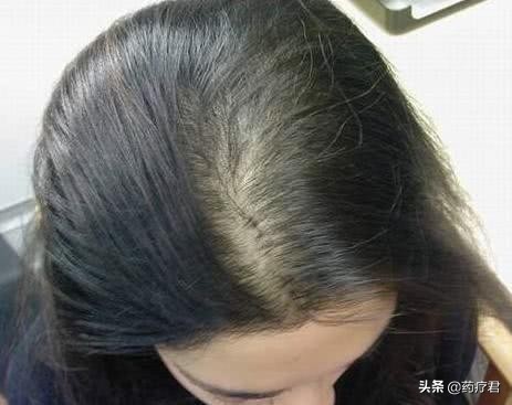女生才20岁出头，就迎来弥漫性脱发，该怎么正确应对？