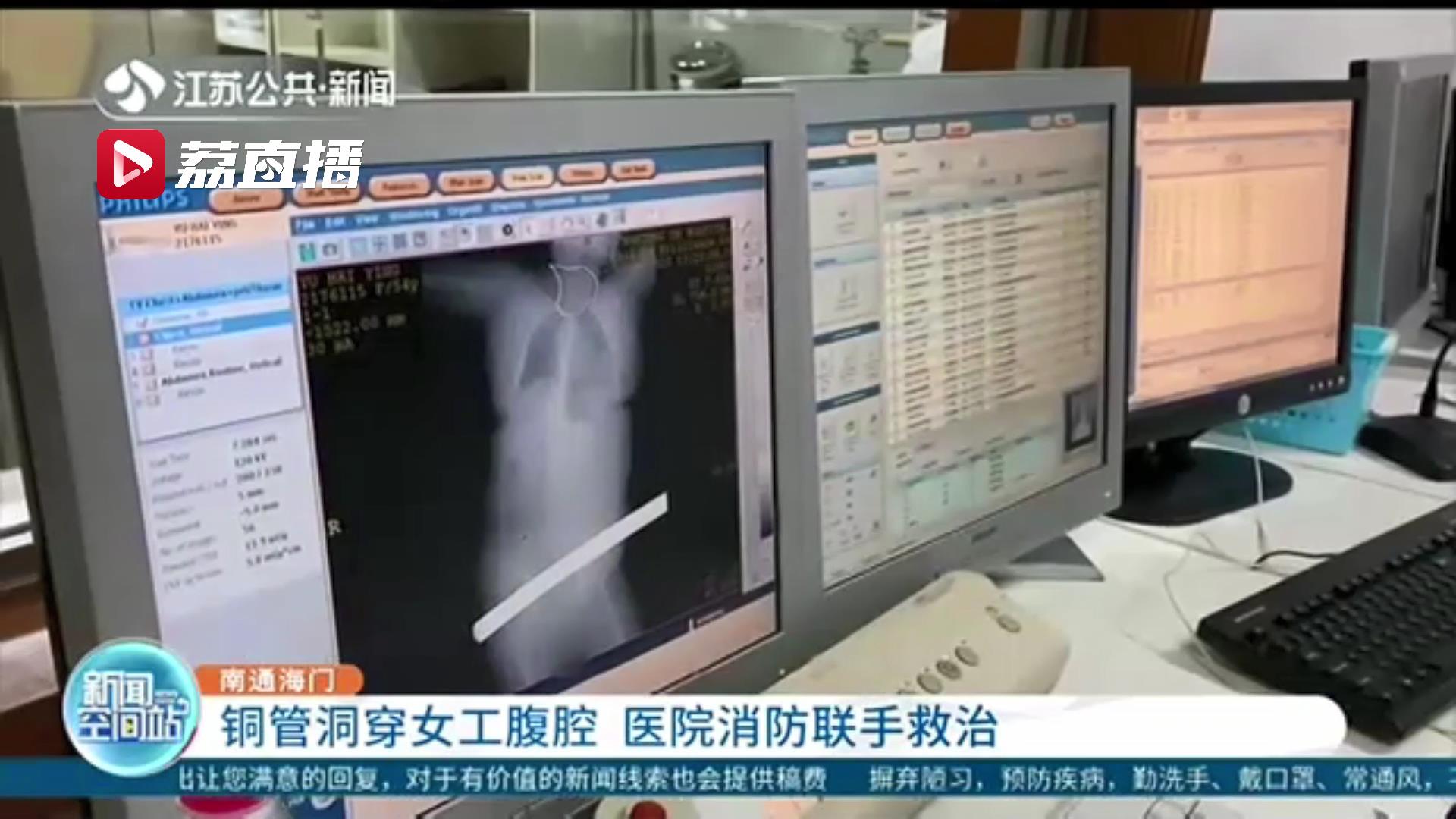 情况危急！铜管洞穿女工腹腔 医院消防联手救治