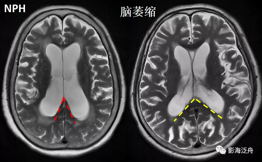 小心误诊，这可不是单纯的脑萎缩