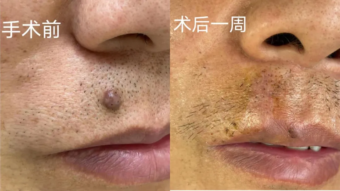 郝醫生祛痣攻略 手術切痣一定會留疤嗎 山西中醫藥大學附院 Mdeditor