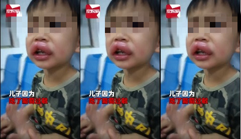 男孩吃葡萄過敏腫成嘟嘟嘴，比擼鐵後肌肉充血還要猛