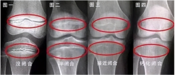 13歲男孩160cm，骨骺線快要閉合，提醒：出現2個特徵前，抓緊補救