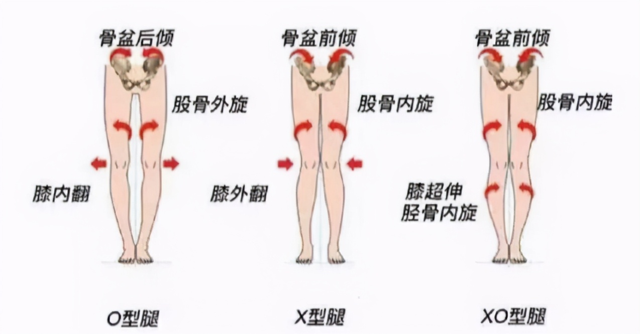 腿型不正和兒時綁腿、穿紙尿褲有關？ 大人這些虐腿做法要立即停止