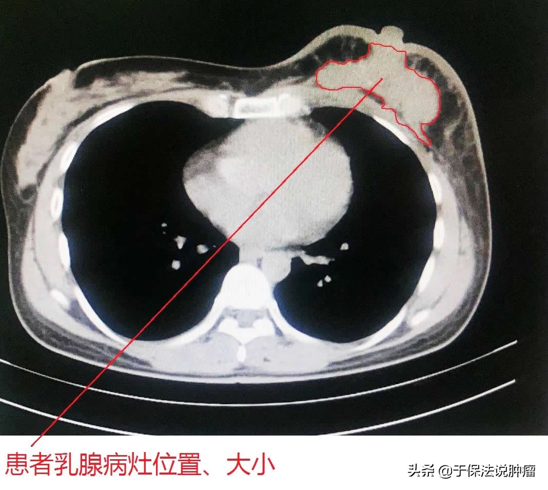 36岁乳腺癌患者化疗副作用大，经缓释库超微创治疗，生存超过7年