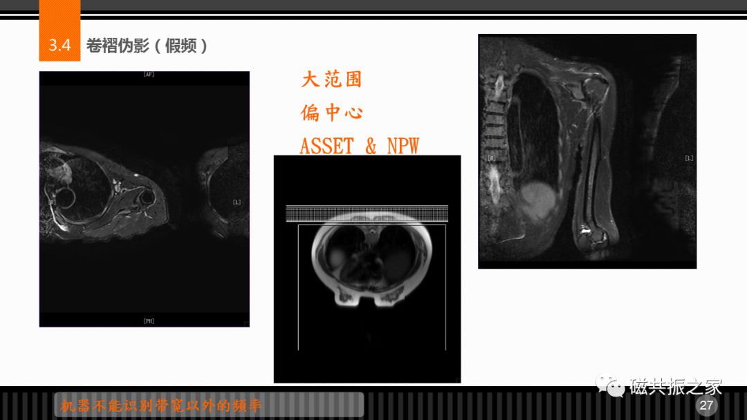 磁共振常见伪影及策略