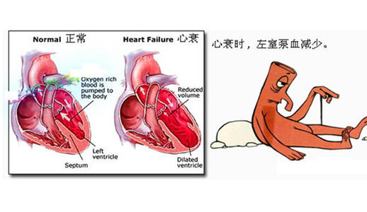 心力衰竭（心衰）为什么会引起胸腔积液？