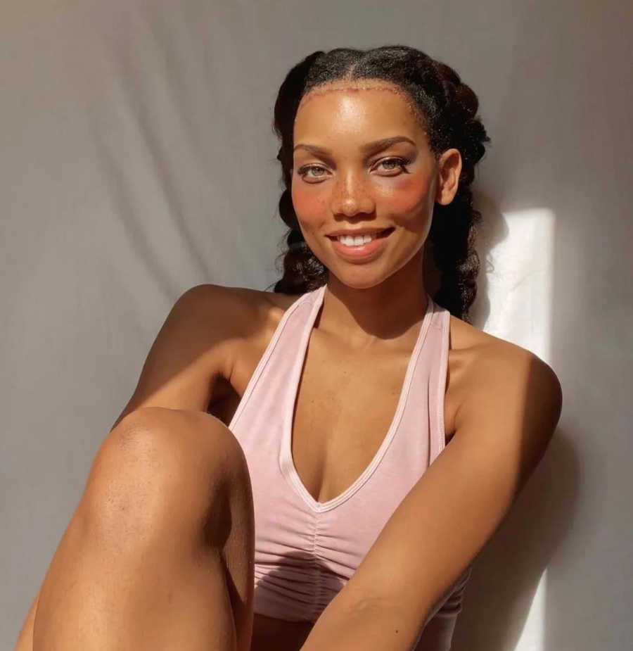 妹纸嫌额头巨大，去做缩额术，将发际线拉低3厘