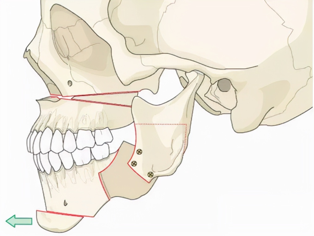 技术重新构建颌面框架,以获得稳定且可预测的上下牙列正常的咬合关系
