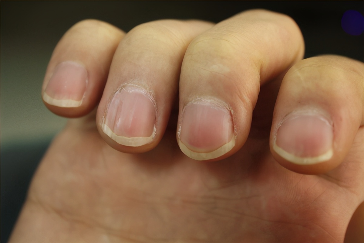 指甲上出現豎紋，是咋回事？ 月牙的多少，與健康有關？