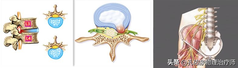 腰部片子显示腰椎间盘突出，您腰痛症状就是它引起的？一文辟谣
