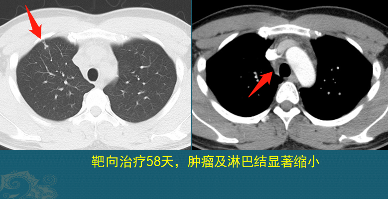 肺癌复发和转移的原因是什么？医生用2个病例，指导正确防癌