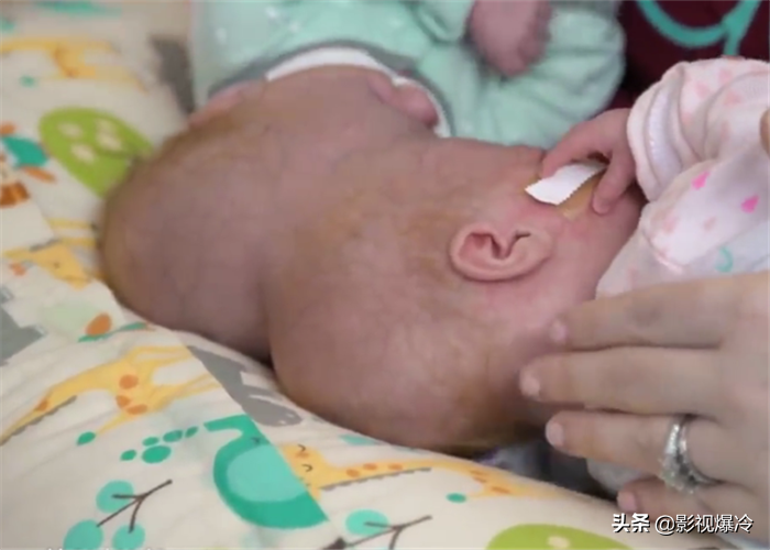 “最奇特的双胞胎”，一个死了另一个会怎样？