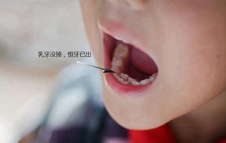 最全儿童换牙时间表：儿童换牙何时开始、何时结束？一图说清