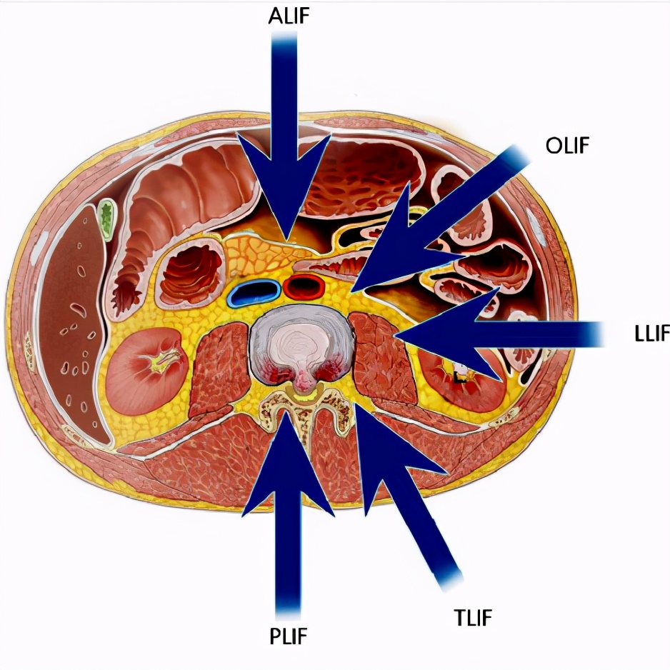文献查阅 | llif-微创外侧腰椎椎体入路的外科血管解剖