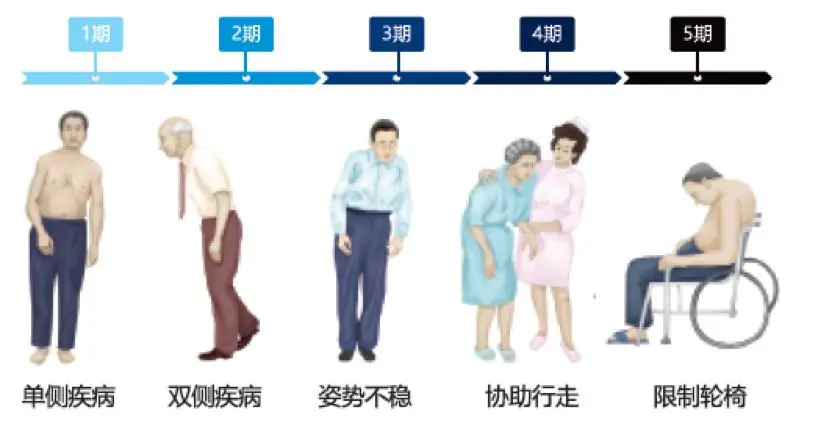 帕金森病程一般是怎么进行发展的？出现这些症状需警惕