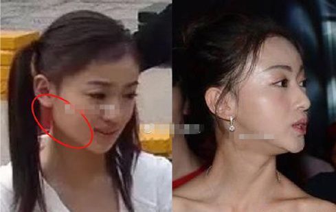 那些一刀切削骨的明星还好吗？后遗症一大堆，小方脸成最大赢家