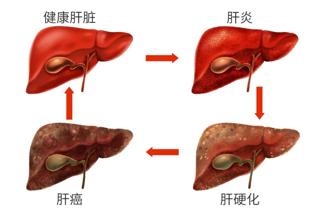 又一影星罹患肝癌！可能导致肝癌的高危因素，你有吗？