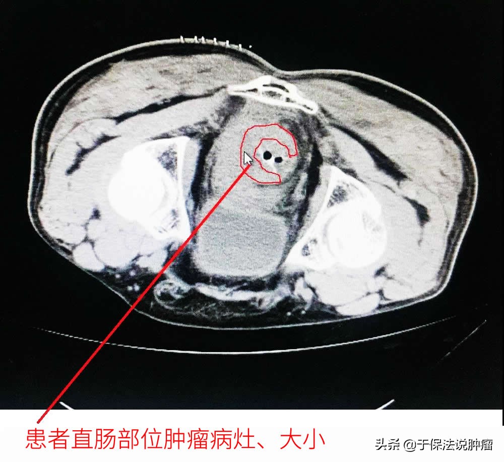 直肠癌侵达浆膜外无法手术，经缓释库治疗，现生存超过7年