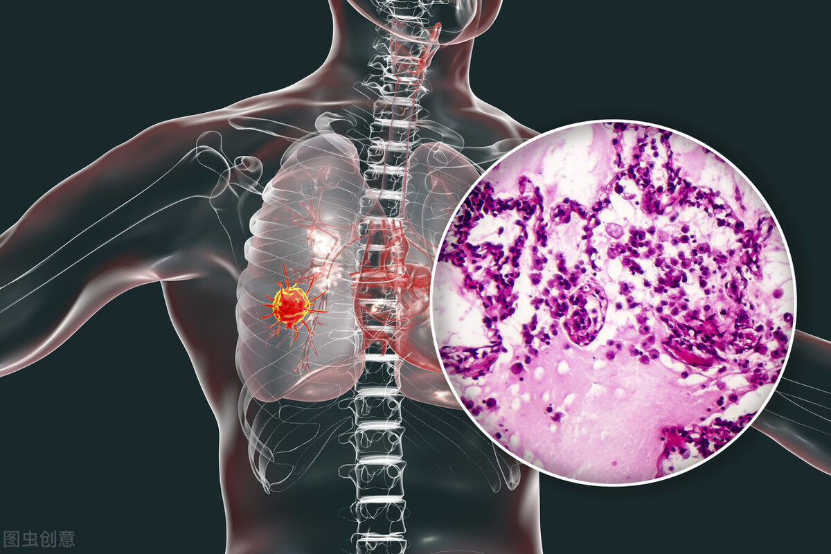 肺癌特效药mobocertinib，获美优先审查