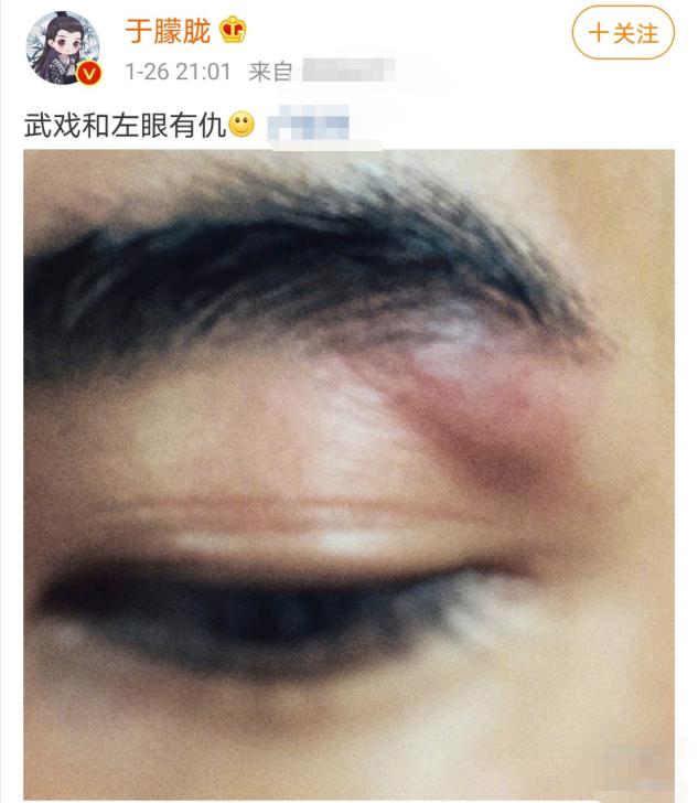 32岁男星拍武打戏左眼受伤,眼部红肿险毁容?曾被内涵靠脸走红