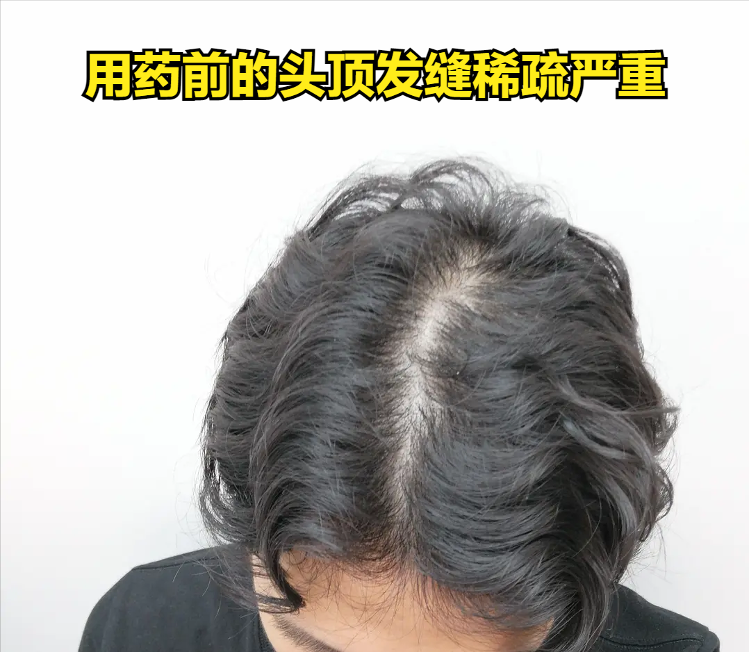 米诺地尔太麻烦，只用非那雄胺能生发？皮肤科医生指导用还是不用