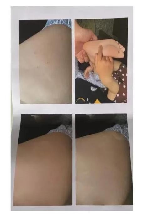 4岁男童被三名幼师扎针数次，针眼遍布全身，家